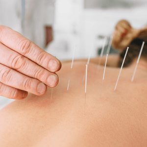 Acupuntura a domicilio Concepción